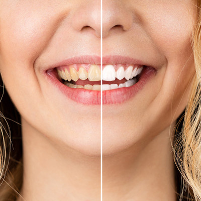 Blanchiment des dents pour esthétique dentaire à Genval | VOCLI Genval